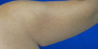 Liposuction Before & After Patient #9422