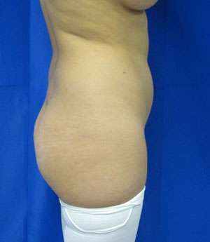 Liposuction Before & After Patient #9439