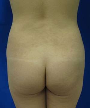 Liposuction Before & After Patient #9462