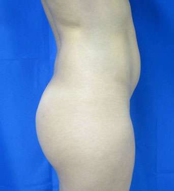 Liposuction Before & After Patient #9467