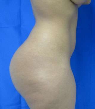 Liposuction Before & After Patient #9472