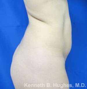 Liposuction Before & After Patient #9519