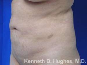 Liposuction Revision Cellulite Reduction Before & After Patient #9658