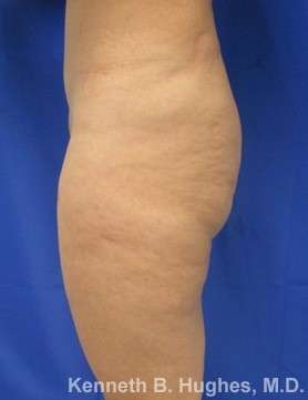 Liposuction Revision Cellulite Reduction Before & After Patient #9669