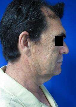 Male Brow Lift Before & After Patient #9679