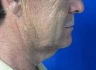 Male Face and Neck Lift Before & After Patient #9709