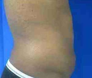 Male Liposuction Before & After Patient #9745