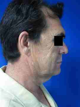 Male Neck Lift Before & After Patient #9774