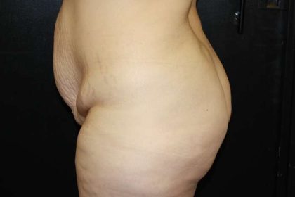 Mommy Makeover Before & After Patient #9820