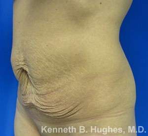 Mommy Makeover Before & After Patient #9848