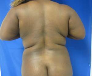 Mommy Makeover Before & After Patient #9905