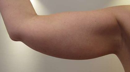 Bodytite Before & After Patient #6175