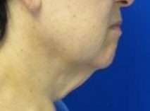 Neck Lift Before & After Patient #10026
