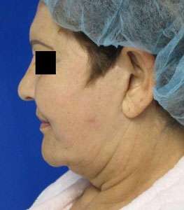 Neck Lift Before & After Patient #10044