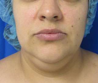 Neck Lift Before & After Patient #10049