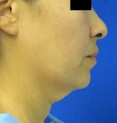 Neck Lift Before & After Patient #10060