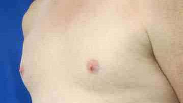 Pec Implants Before & After Patient #10068