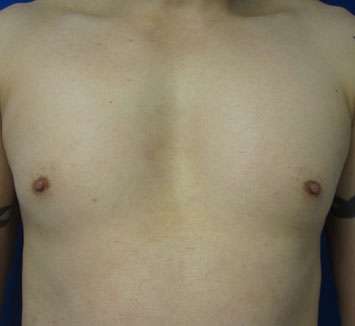 Pec Implants Before & After Patient #10073