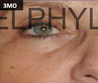 PRP for Facial Rejuvenation Before & After Patient #10078