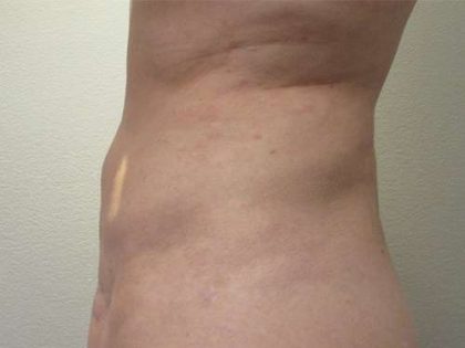 Abdomen Before & After Patient #5866