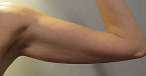 Bodytite Before & After Patient #6189
