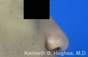 Rhinoplasty Before & After Patient #10110