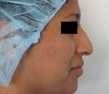 Rhinoplasty Before & After Patient #10147