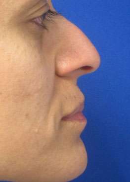 Rhinoplasty Before & After Patient #10175