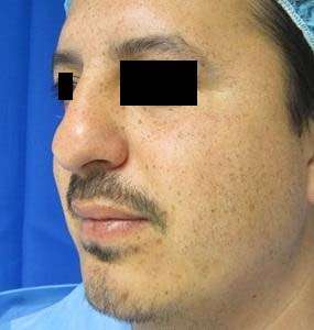 Rhinoplasty Before & After Patient #10188