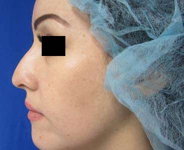 Rhinoplasty Before & After Patient #10196