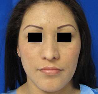 Rhinoplasty Before & After Patient #10201