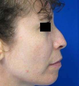 Rhinoplasty Before & After Patient #10239