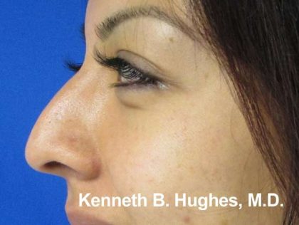 Rhinoplasty Before & After Patient #10250