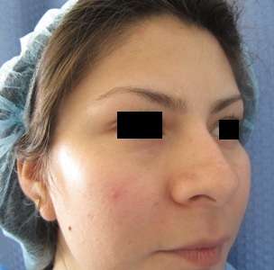 Rhinoplasty Before & After Patient #10261