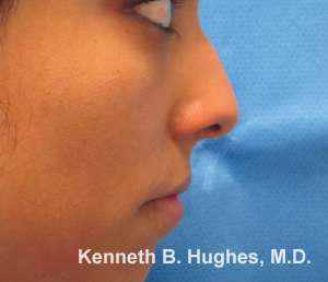 Rhinoplasty Before & After Patient #10277
