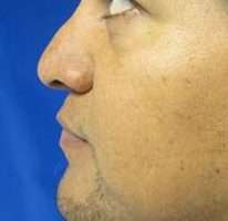 Rhinoplasty Before & After Patient #10288