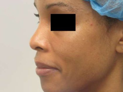 Rhinoplasty Before & After Patient #10318