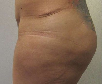 Silicone Injections Biopolymer Removal Before & After Patient #10347