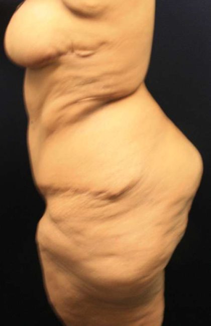 Thigh Lift Before & After Patient #10360