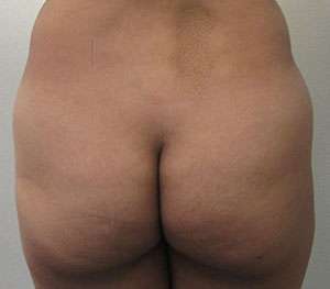 Tummy Tuck Before & After Patient #10410