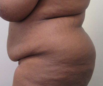 Tummy Tuck Before & After Patient #10418