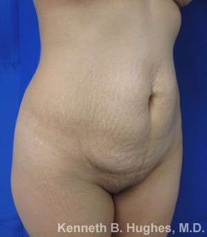 Tummy Tuck Before & After Patient #10482