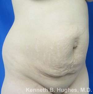 Tummy Tuck Before & After Patient #10508