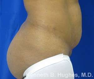 Tummy Tuck Before & After Patient #10539