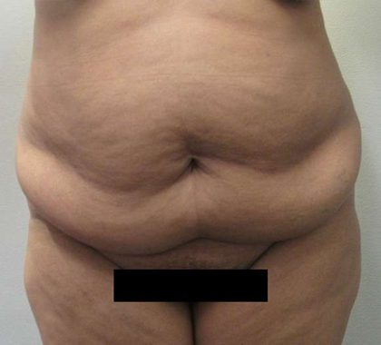 Tummy Tuck Before & After Patient #10585