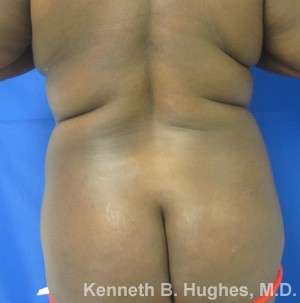Tummy Tuck Before & After Patient #10604