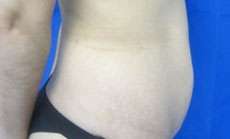 Tummy Tuck Before & After Patient #10639