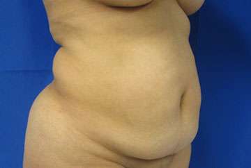 Tummy Tuck Before & After Patient #10737