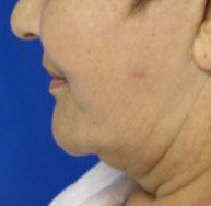 Brow Lift Before & After Patient #8129