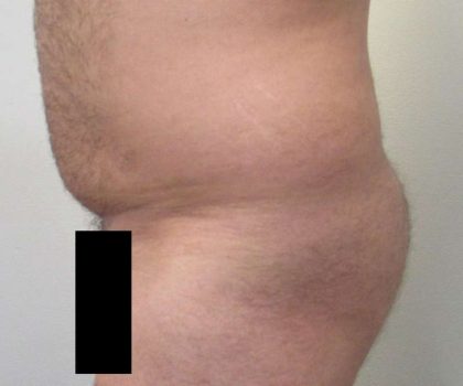 Brazilian Butt Lift Before & After Patient #6223